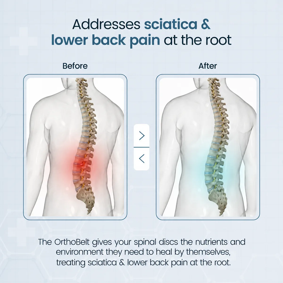 Addresses sciatica and lower back pain at the root – before and after